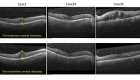 A series of images of thin, almost transparent lines in black and white, which are retinal scans created with OCT 